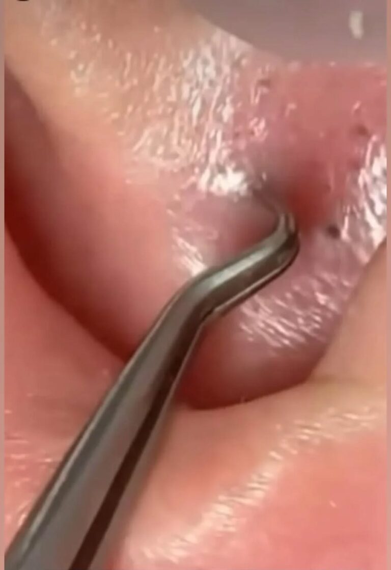 Best 15 Tips For Squeezing Blackheads On Nose