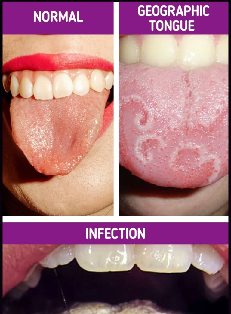 Your Tongue Can Alert You to Health Problems